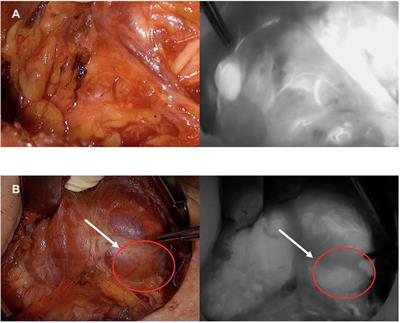 Indocyanine green (ICG) angiography-guided thyroidectomy: description of surgical technique